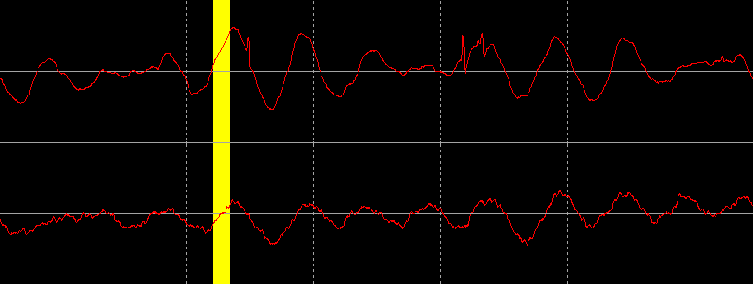 A vinyl waveform including several small scratches one of which has been removed by interpolation loaded into digital sound editing software